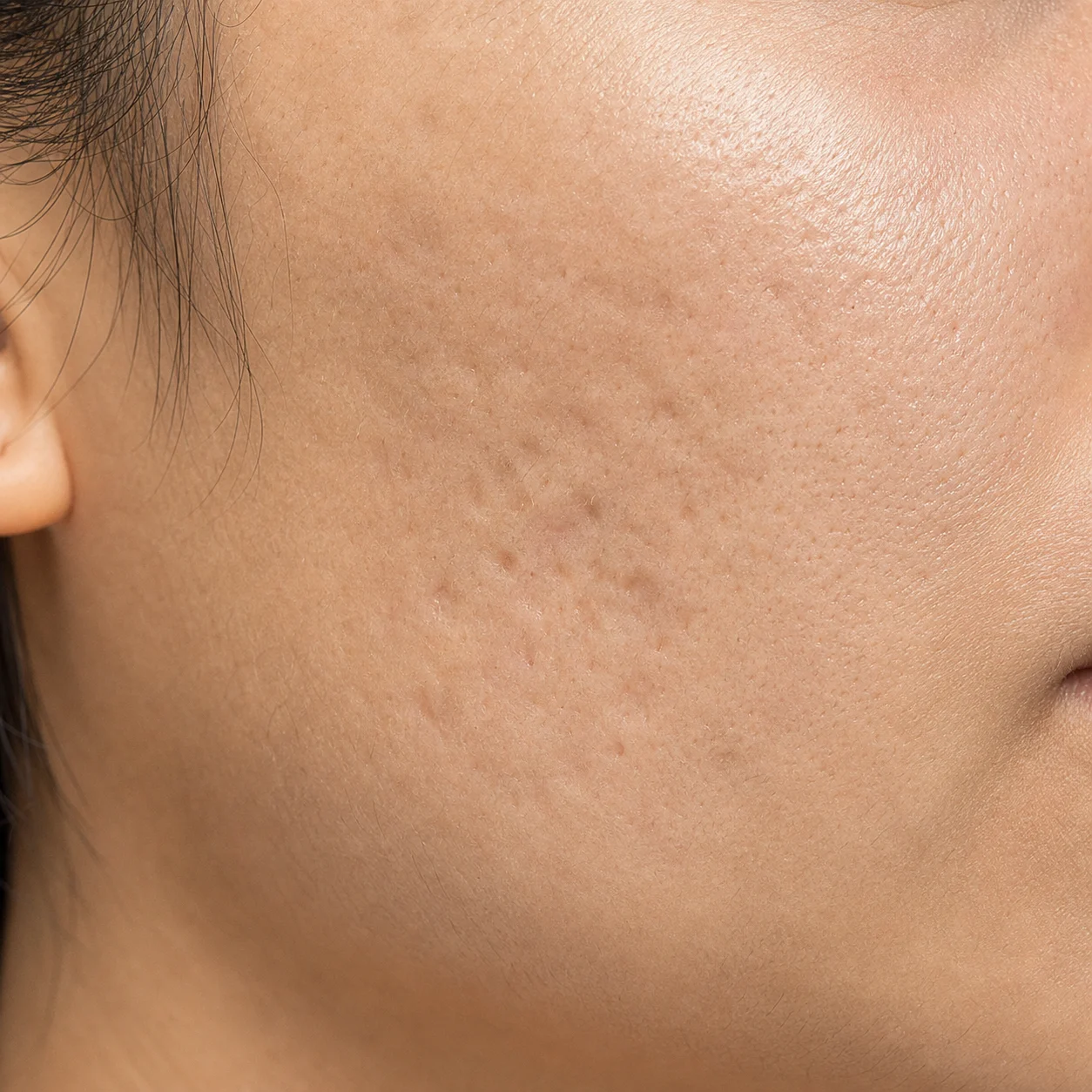 Rolling and boxcar depressed acne scars left on cheek skin