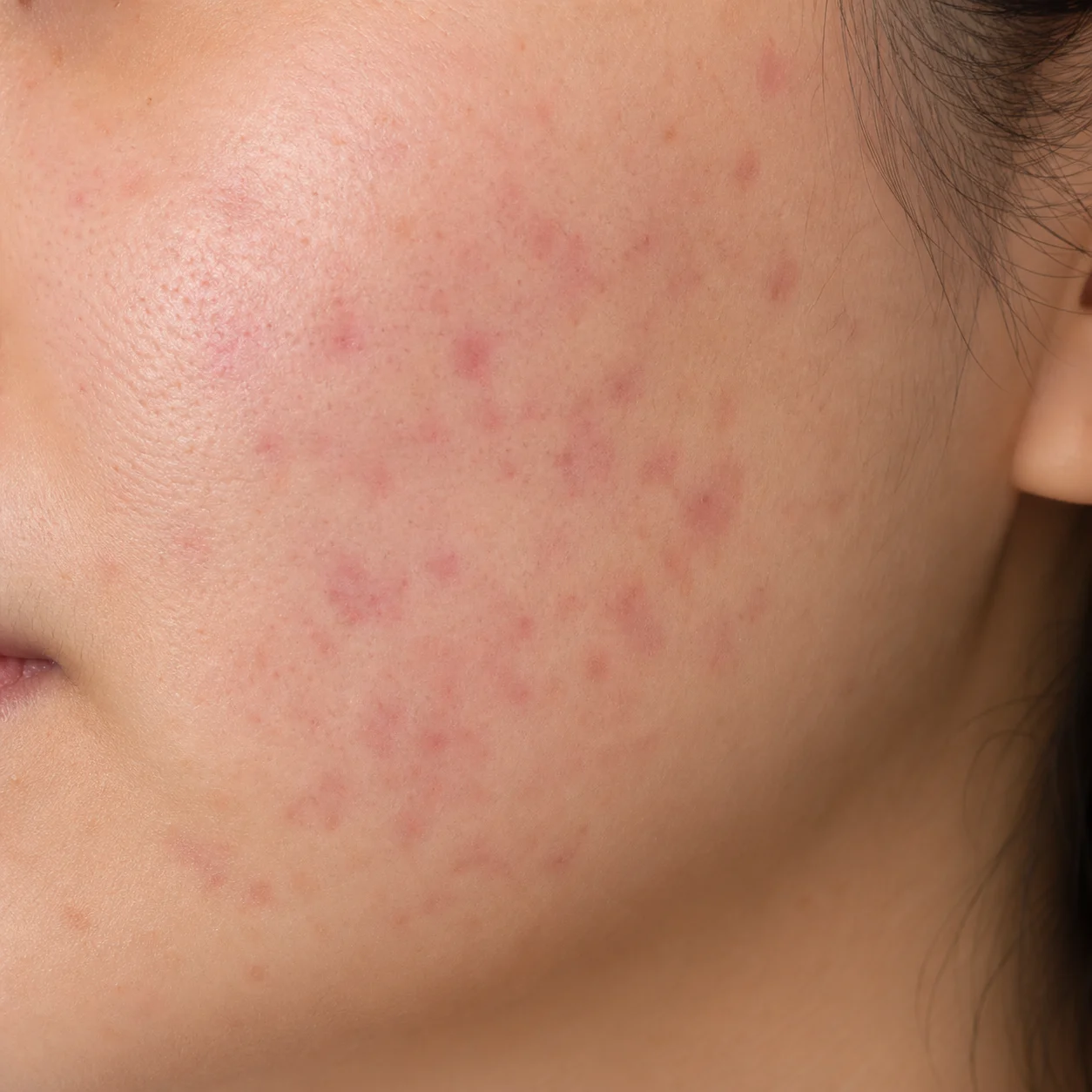 Flat red marks left on the cheek after acne has subsided