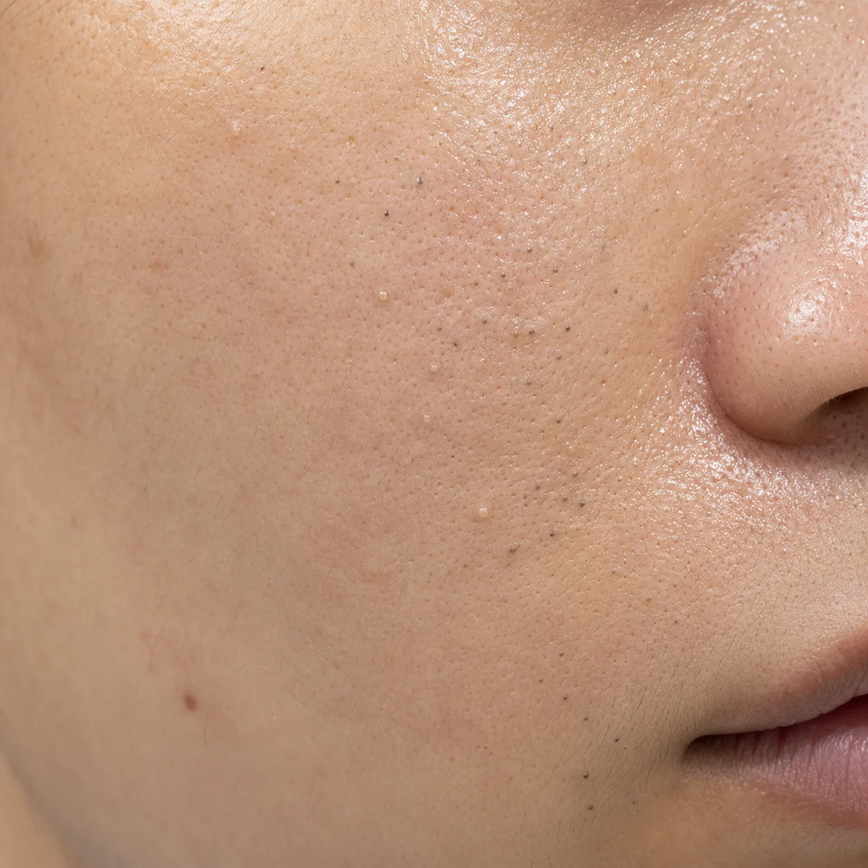 Skin showing excess sebum, clogged pores, and comedones