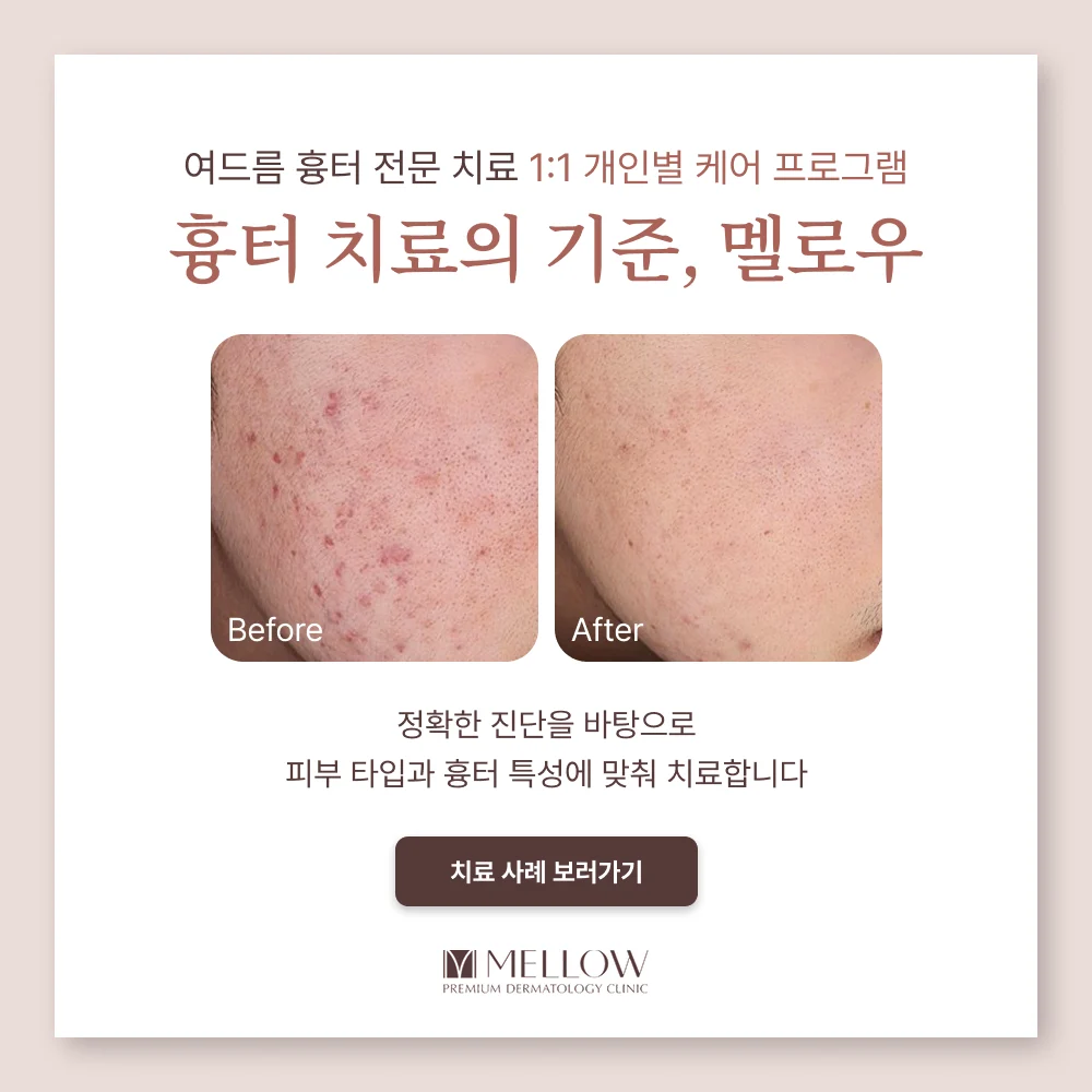 멜로우피부과 여드름 치료 후기