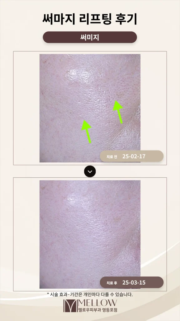 앞볼 처짐 써마지 리프팅 후기