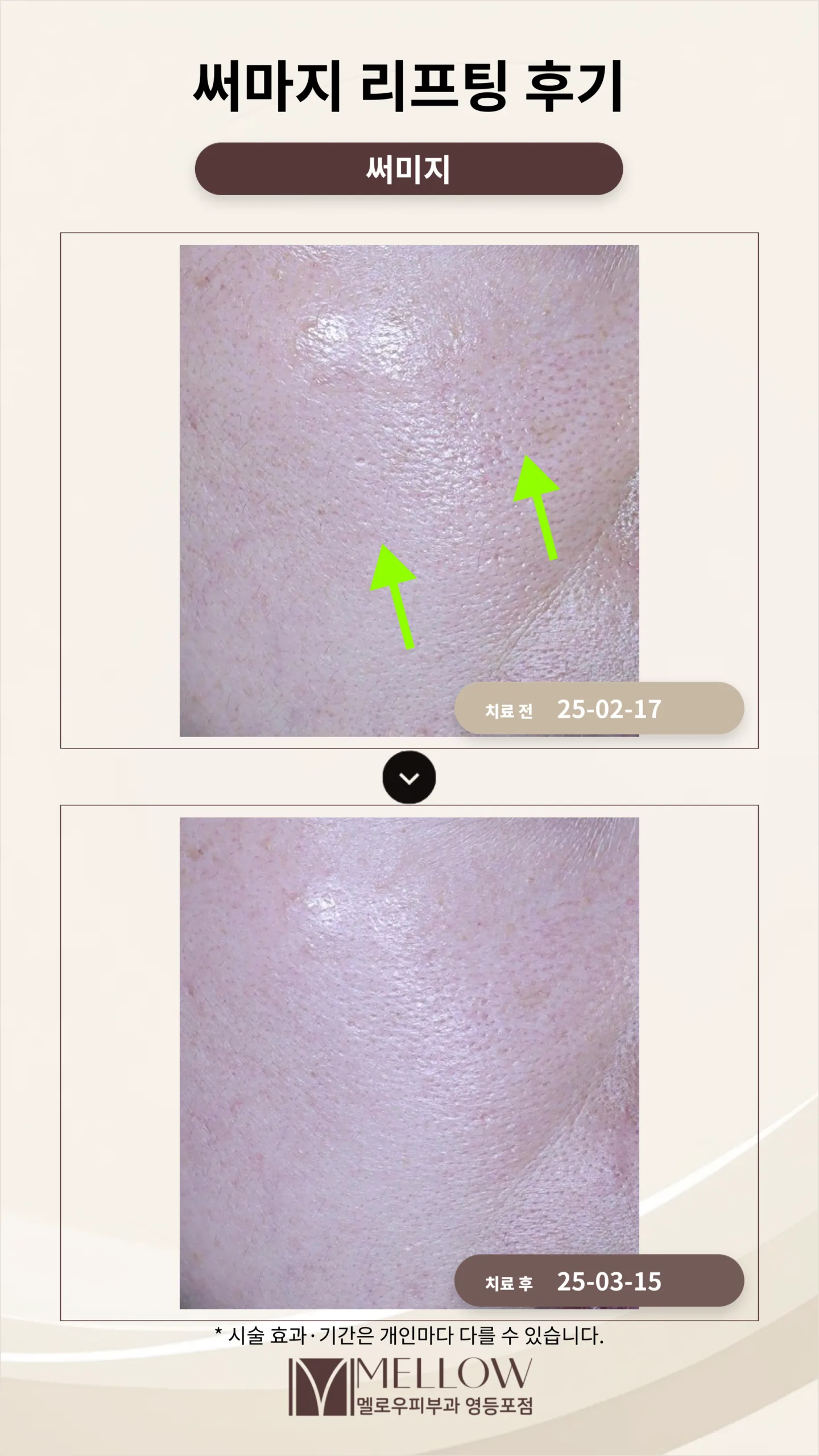 40대 여성 앞볼 처짐 써마지 시술 전후 비교 사진