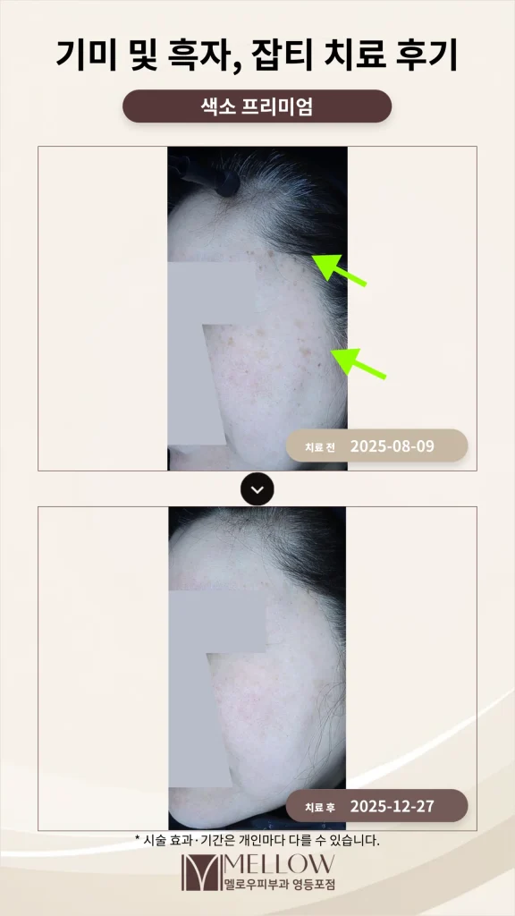 60대 얼굴 전체 흑자·잡티 색소 치료 후기