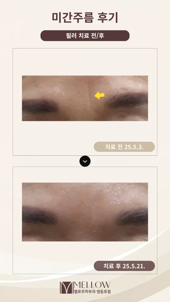 60대 여성 미간 주름 필러 시술 후기