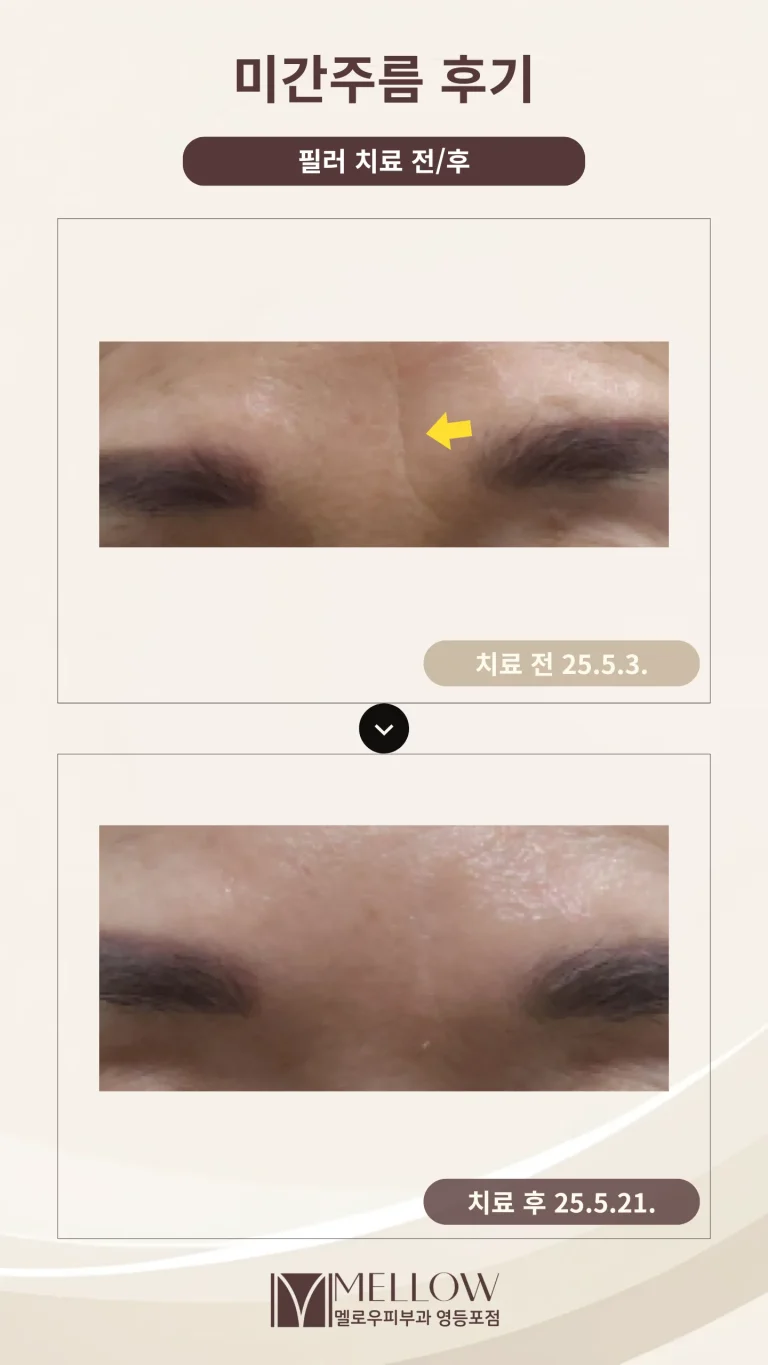 60대 여성 미간 주름 필러 후기