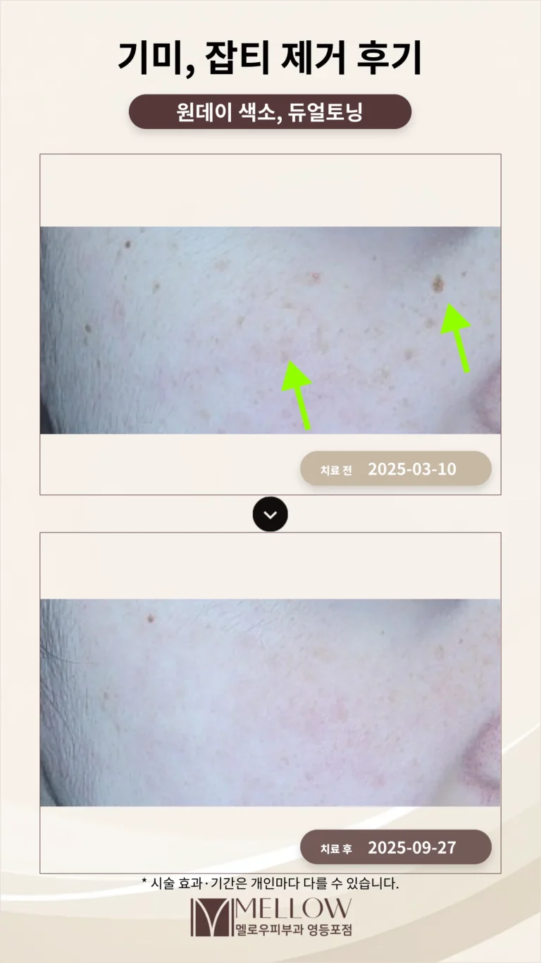 40대 기미, 잡티 제거 후기 #부작용 적은 레이저 치료 방법