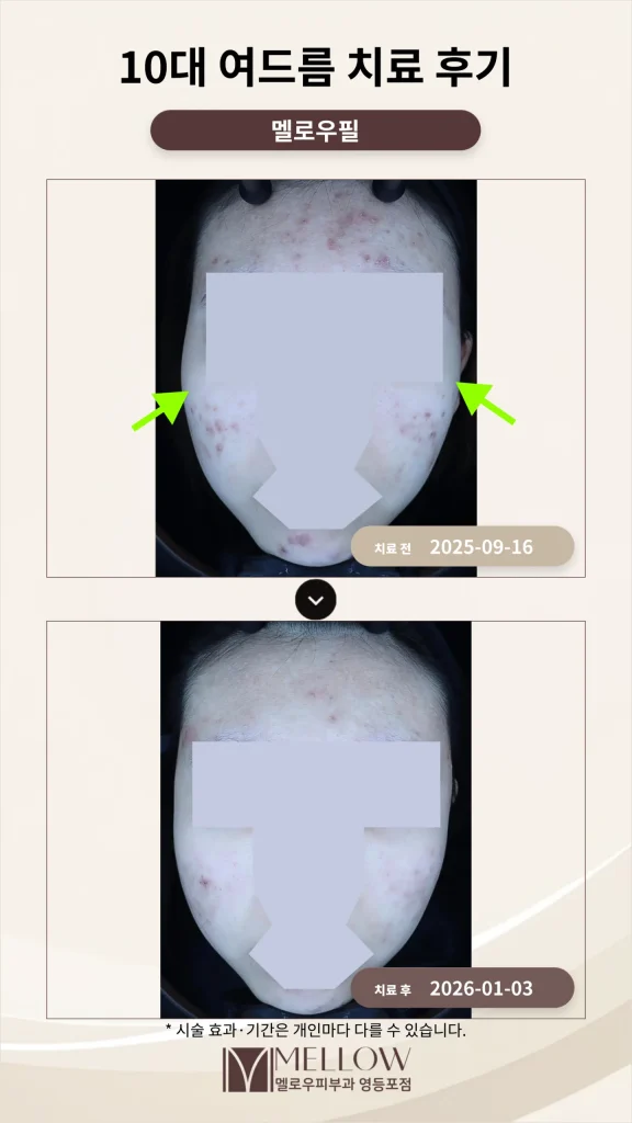 10대 여드름 멜로우필 치료 후기