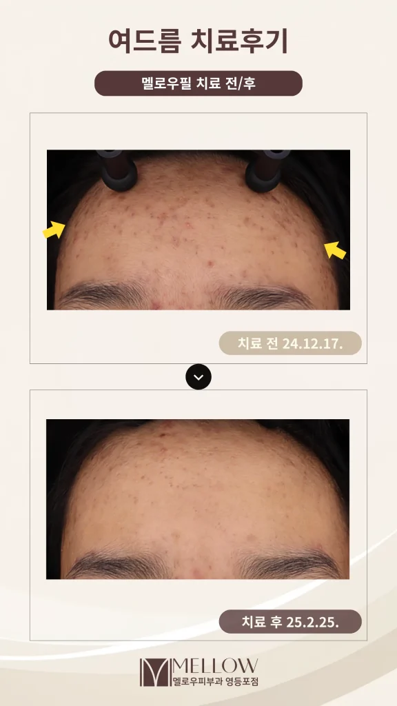 10대 남성 이마 여드름 5회 치료 후기