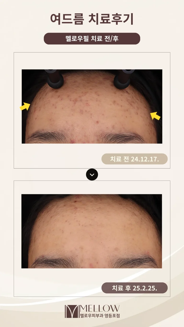 10대 이마 염증성 여드름 치료 후기