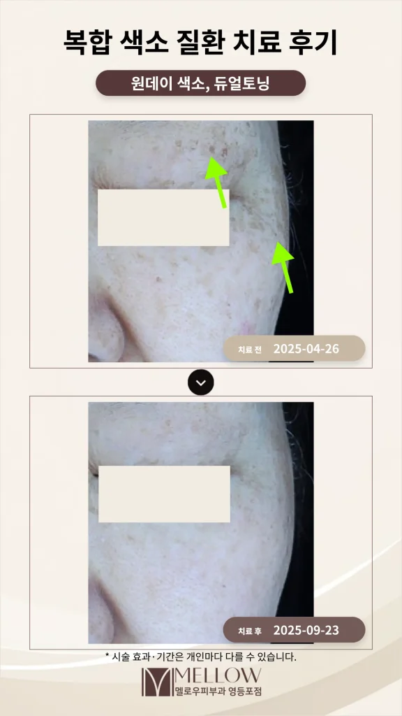 기미·잡티·흑자 복합 색소질환 치료 후기