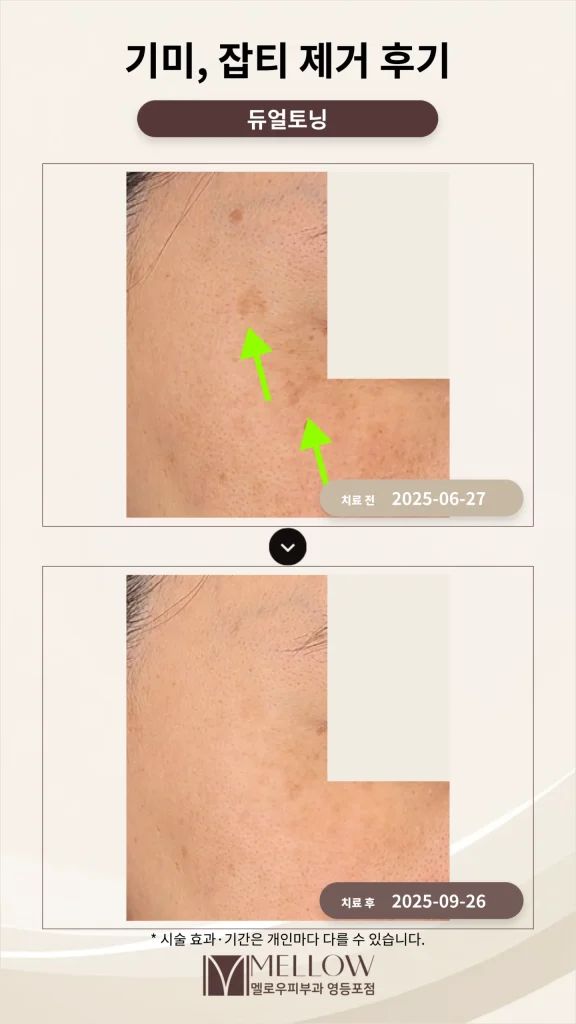 눈가·관자 기미 레이저토닝 치료 후기