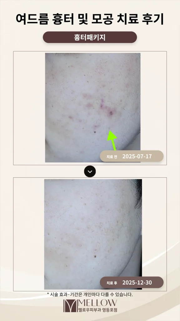 여드름 흉터·모공 포텐자 치료 후기