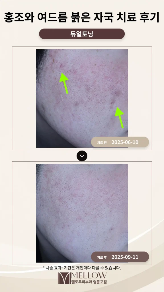 홍조와 여드름 붉은 자국 동반 치료 후기