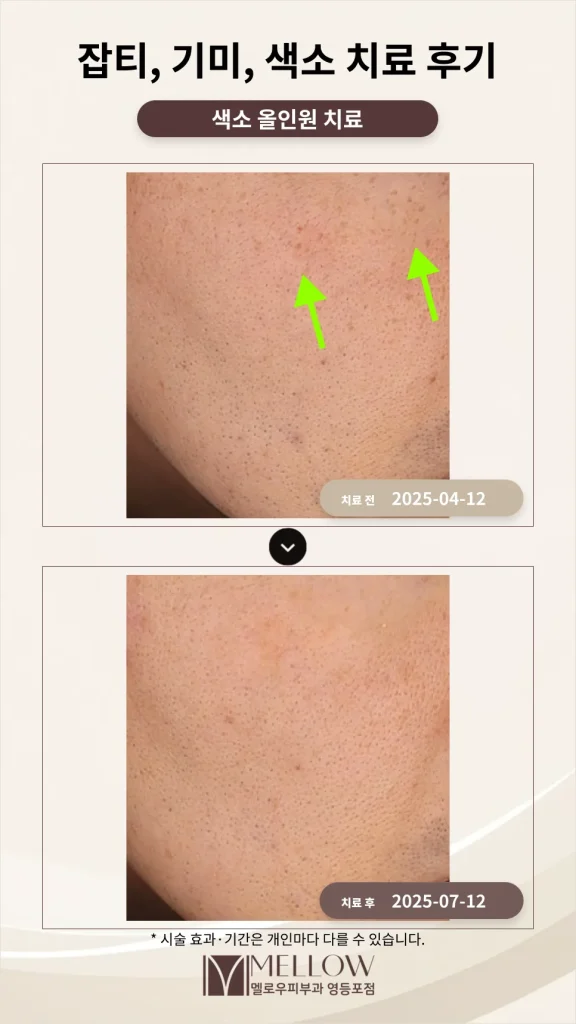 40대 남성 잡티·기미 색소 치료 후기