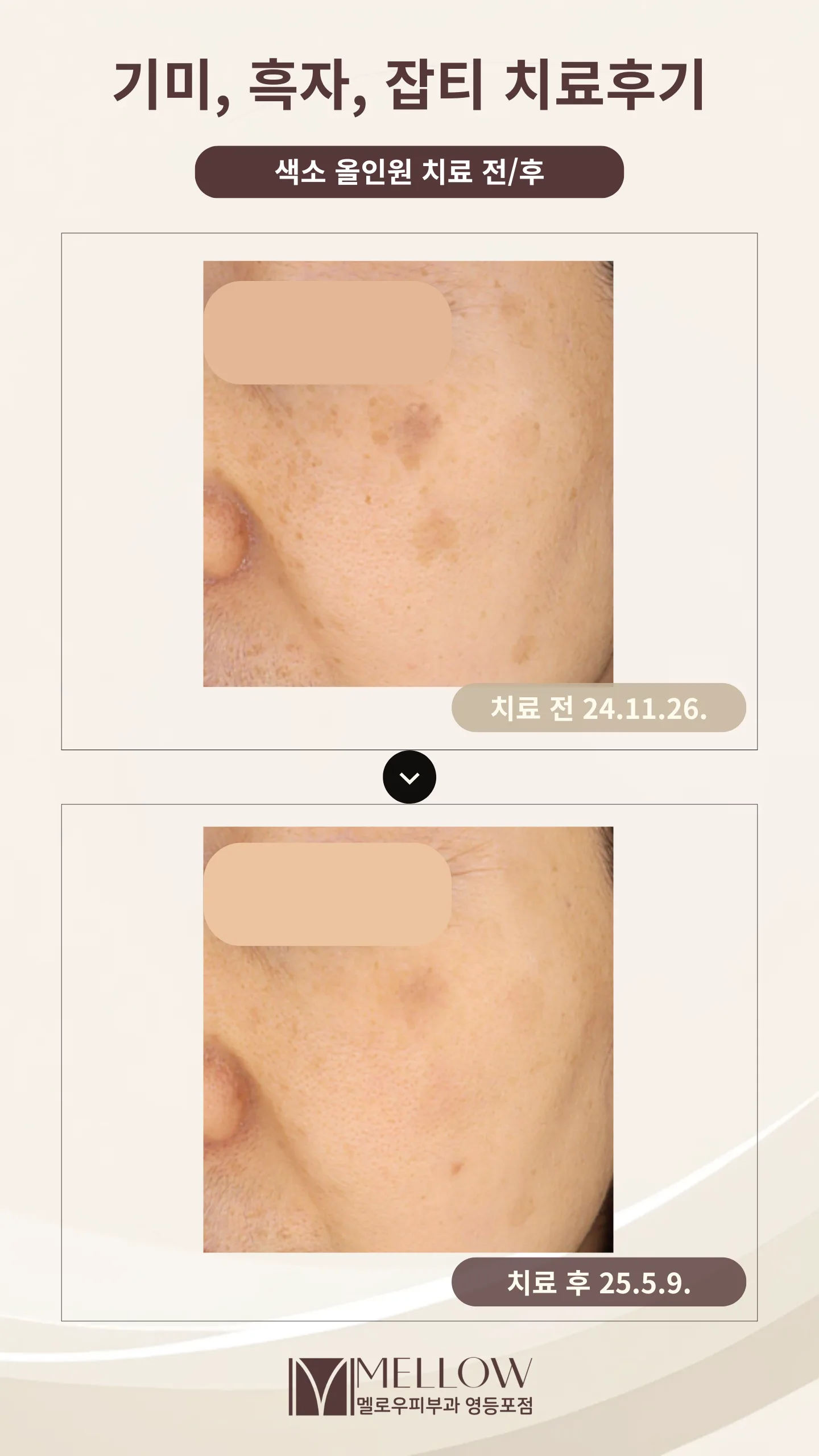 기미와 흑자가 혼재한 색소 올인원 치료 전후 비교 사진
