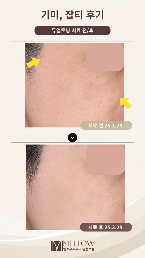 30대 남성 기미·잡티 듀얼토닝 10회 후기