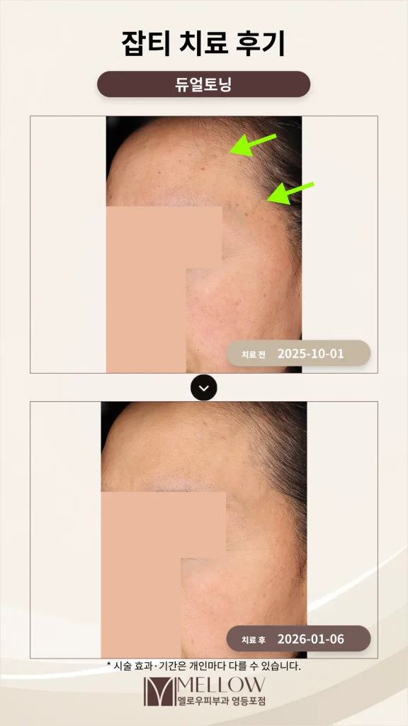 이마·헤어라인 잡티 제거 후기