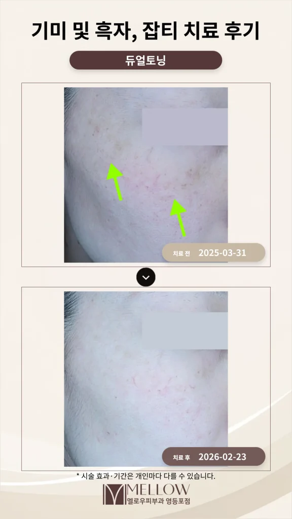 기미·흑자·잡티 복합 색소 치료 후기