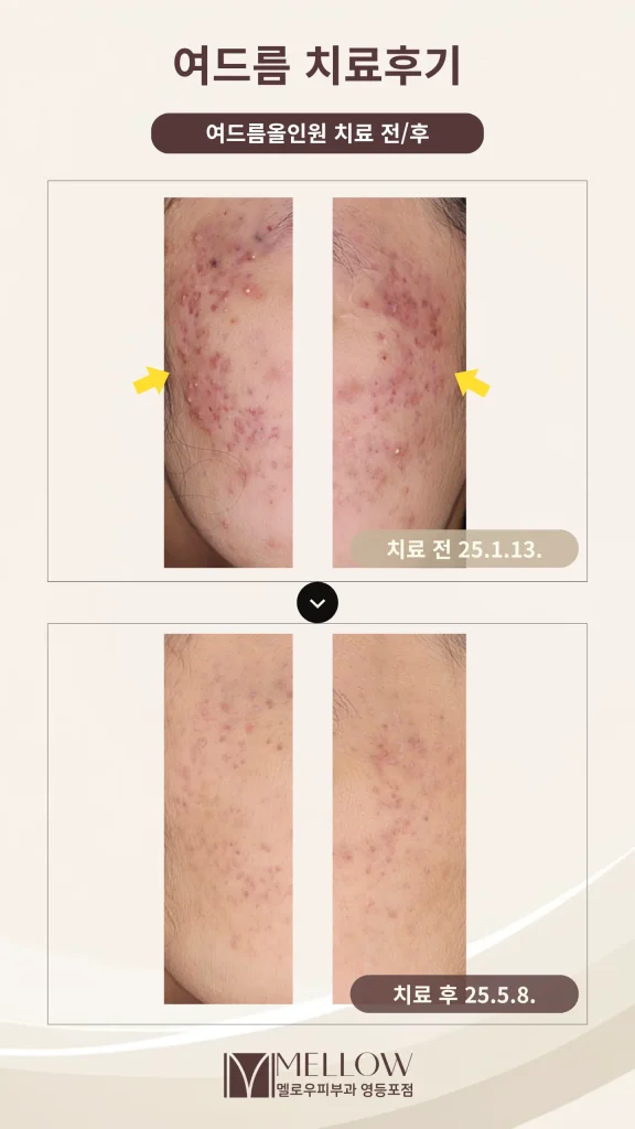 10대 화농성 여드름 올인원 8회 후기