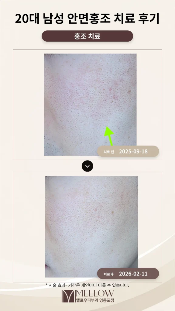 20대 남성 안면홍조 레이저 치료 후기