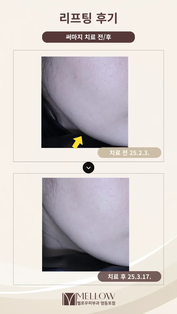 30대 여성 써마지 턱선 리프팅 후기