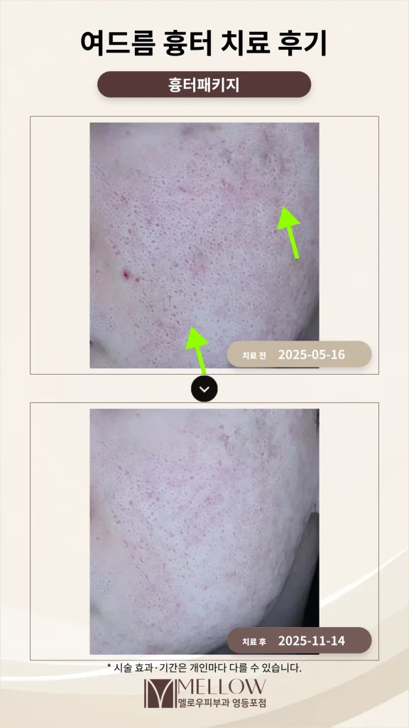 30대 남성 여드름 흉터 치료 후기