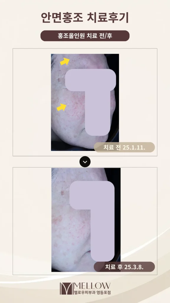 60대 모세혈관 확장증·만성 홍반 치료 후기