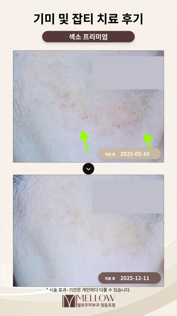 눈밑·광대 기미 듀얼토닝 치료 후기