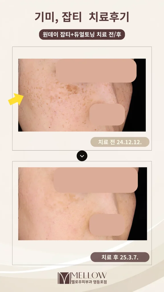 40대 여성 광대 주근깨형 잡티 레이저토닝 후기