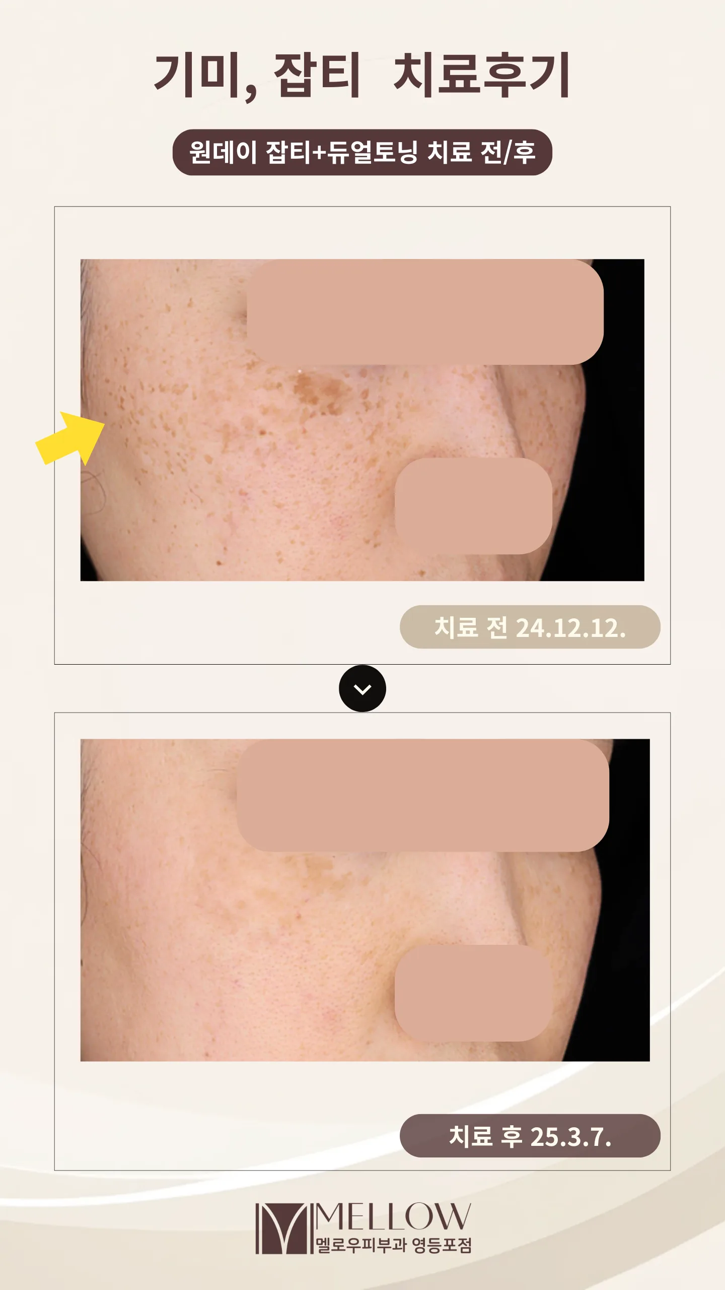 40대 여성 광대 주근깨형 잡티 레이저토닝 전후 비교 사진