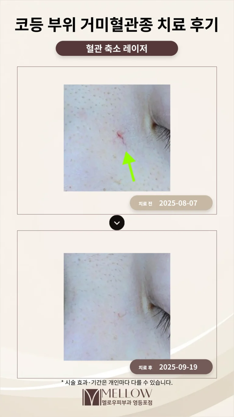 30대 코등 부위 붉은 자국, 거미혈관종 치료 후기