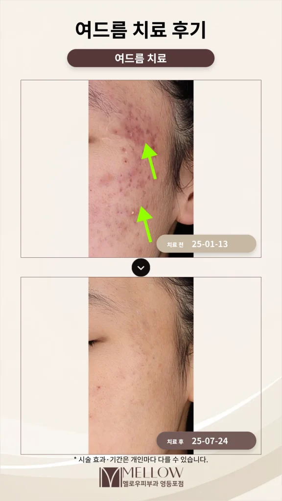 10대 여드름 치료 후기_효과적인 여드름 치료 방법