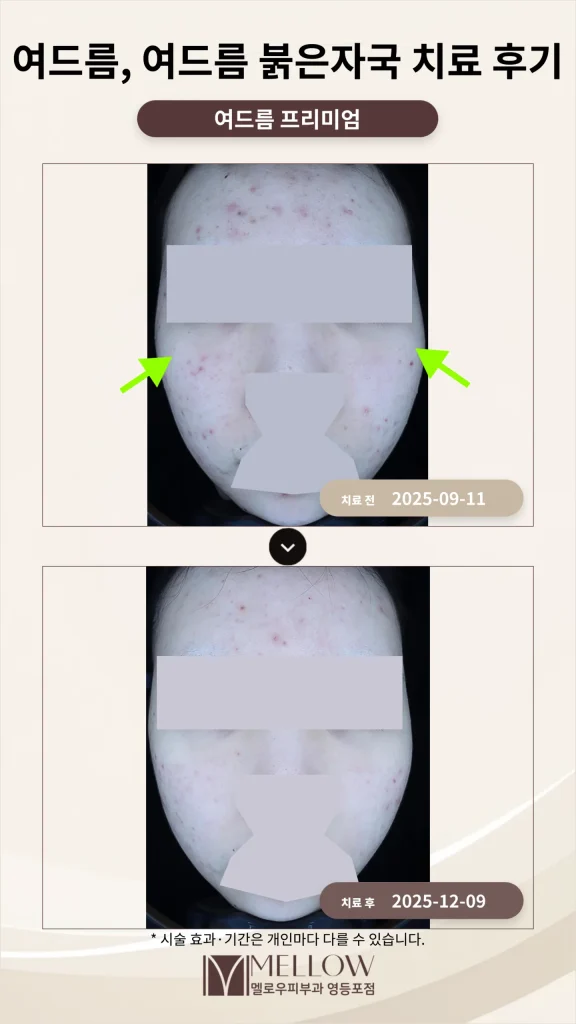 반복되는 여드름·붉은 자국 치료 후기