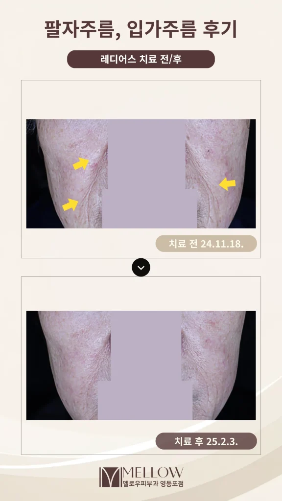 60대 팔자·입가 주름 래디어스 시술 후기