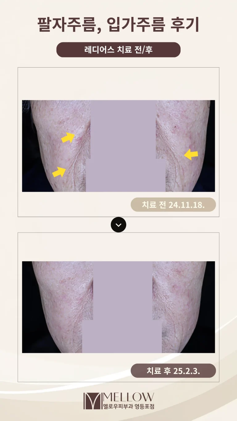 60대 여성 팔자주름 입가주름 래디어스 후기