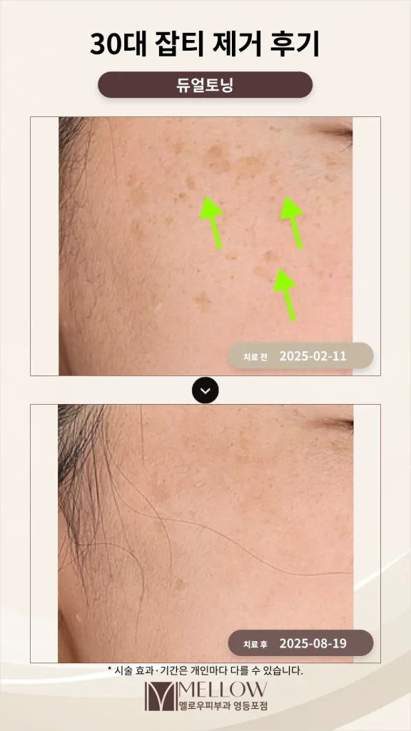 예민한 피부 광대 잡티 토닝 후기