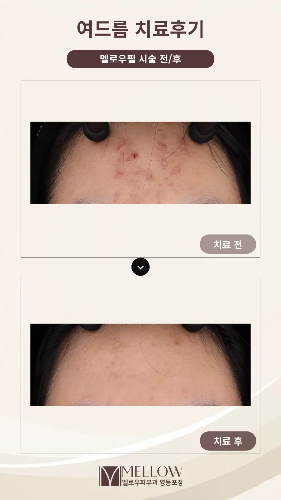 이마 여드름 스케일링 5회 치료 후기