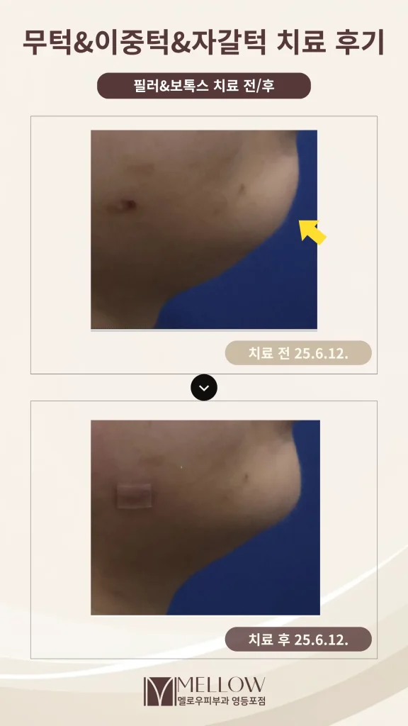 20대 여성 무턱·이중턱 필러 시술 후기