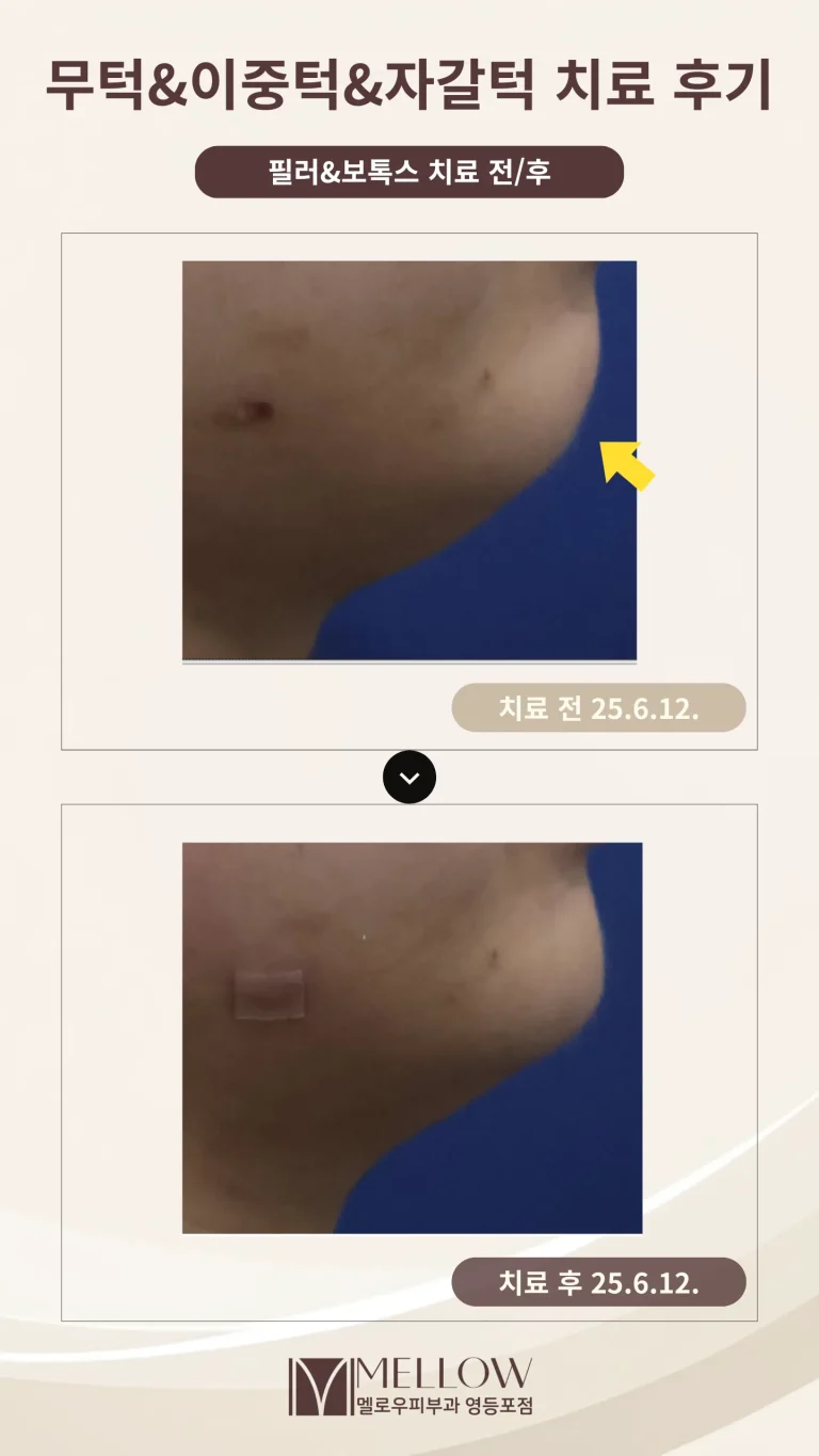 20대 무턱 이중턱 필러 후기