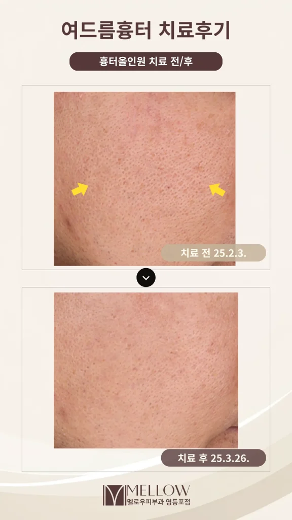 아이스픽형 패인 여드름 흉터 5회 치료 후기
