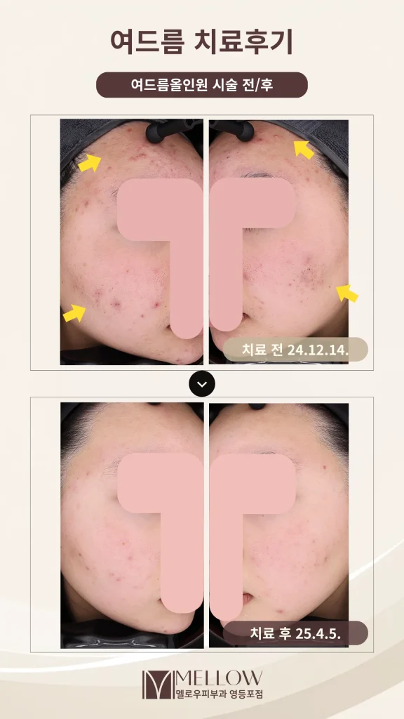 여드름 올인원 주 1회·4회 치료 후기