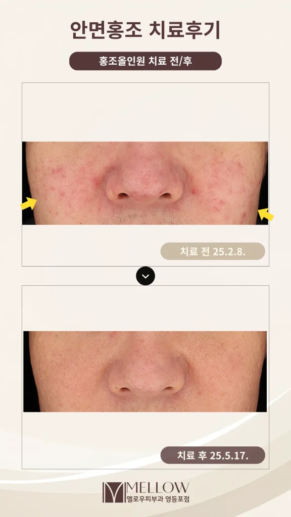 50대 남성 안면홍조 올인원 5회 후기