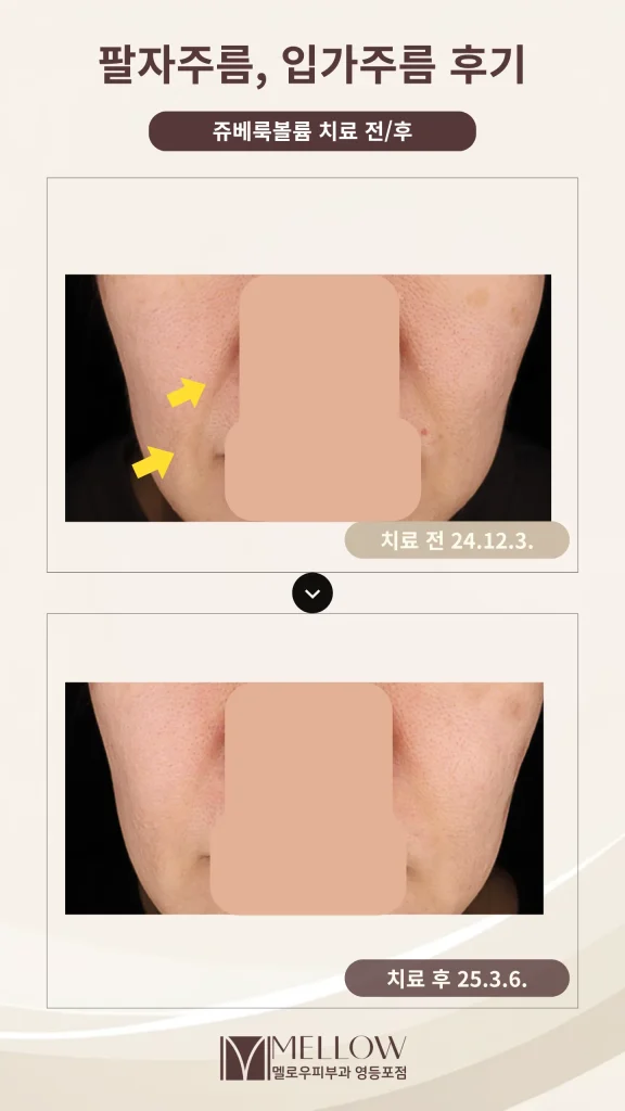 50대 팔자주름 쥬베룩 볼륨 시술 후기
