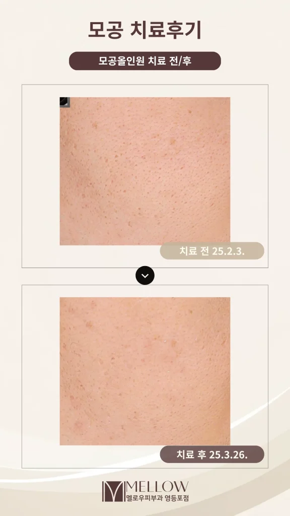 볼 모공 축소 5회 치료 후기