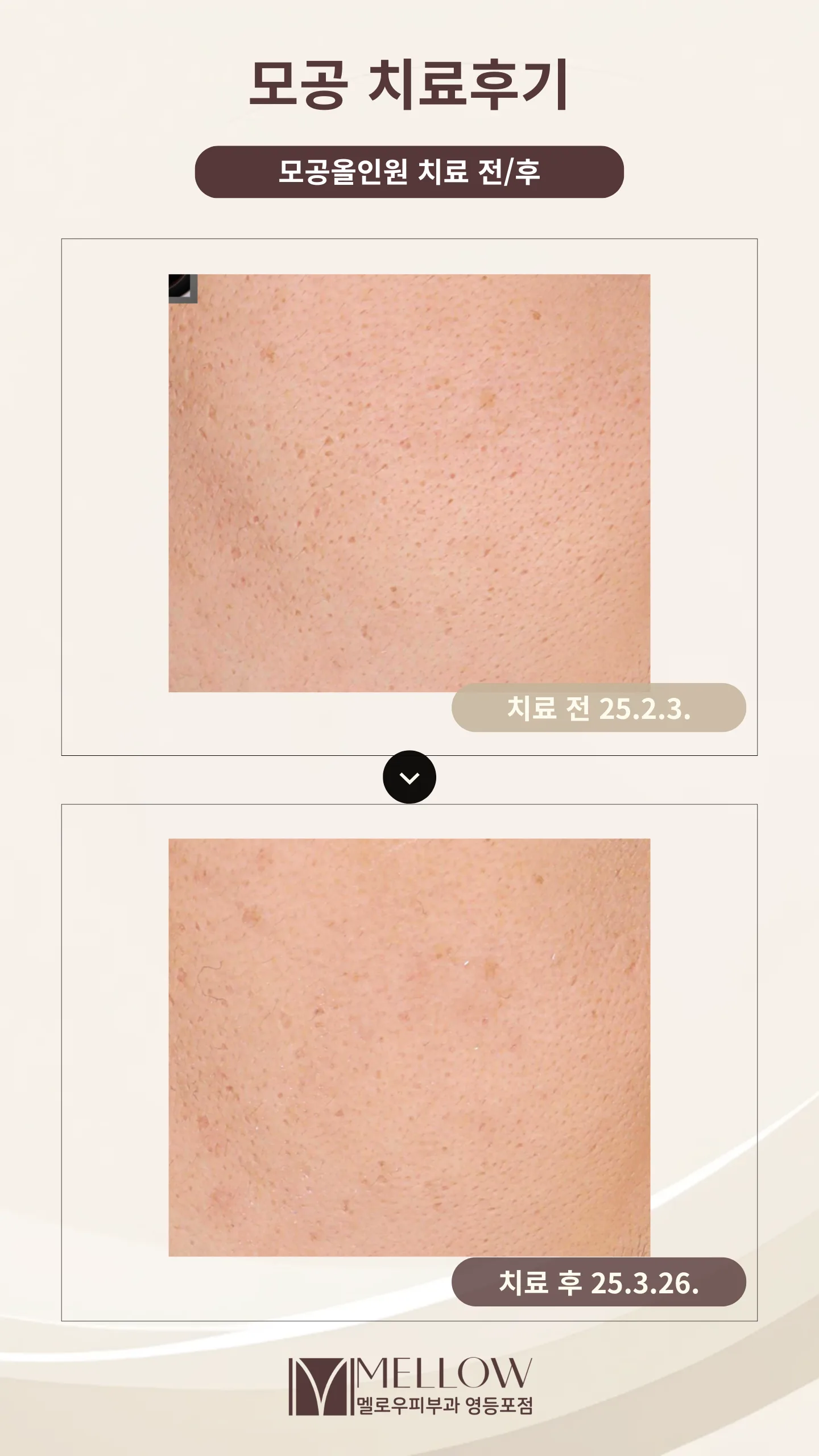 볼 모공 5회 치료 사례
