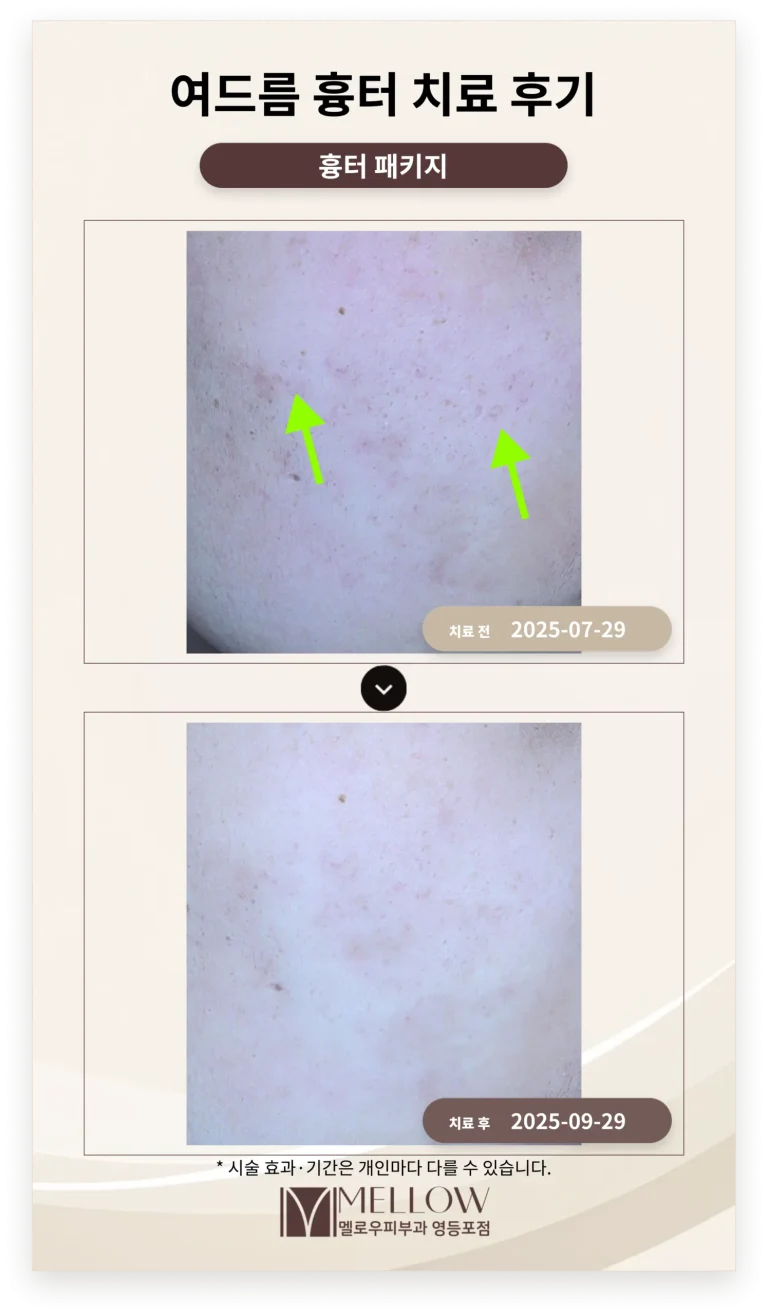 20대 여드름 흉터 치료 후기