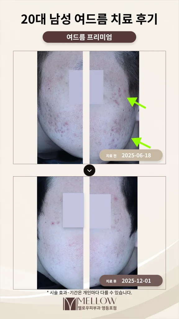 20대 남성 여드름 프리미엄 치료 후기