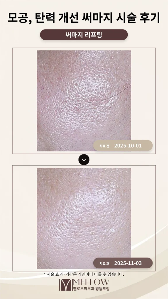 50대 여성 모공·탄력 써마지 시술 후기