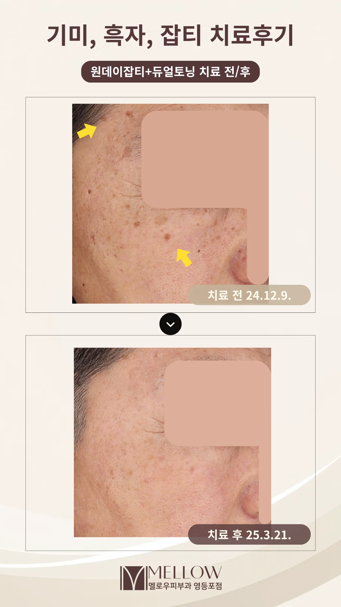 60대 남성 흑자와 기미 레이저 치료 전후 비교 사진