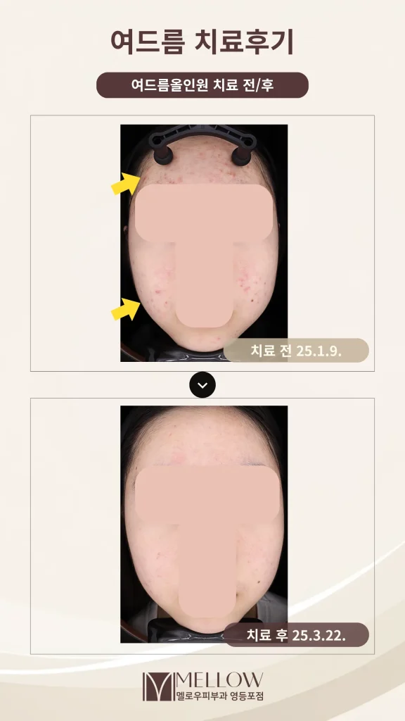 10대 여성 얼굴 전체 여드름 8회 치료 후기